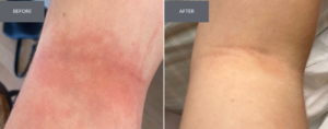 A before an after image of an arm that was treated with niacinamide for eczema