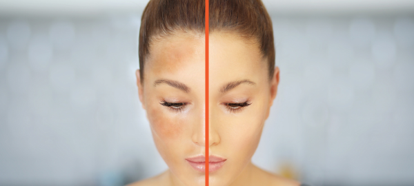 Woman with patches of hyperpigmentation, sun damage or melasma.