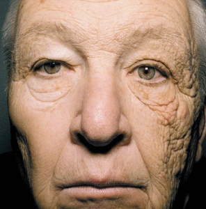 Image of a truck driver's face, illustrating sun damage / photoageing to the side closest to the window.